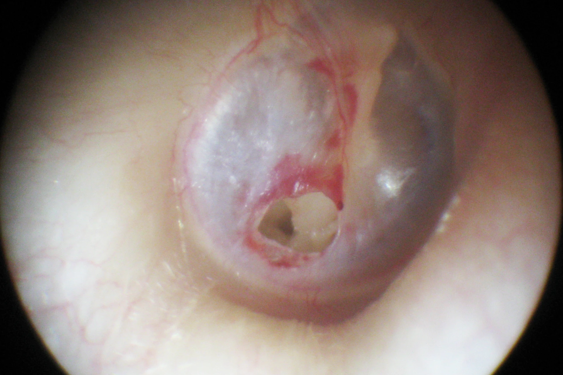 Perforacija bobniča in kronično vnetje srednjega ušesa